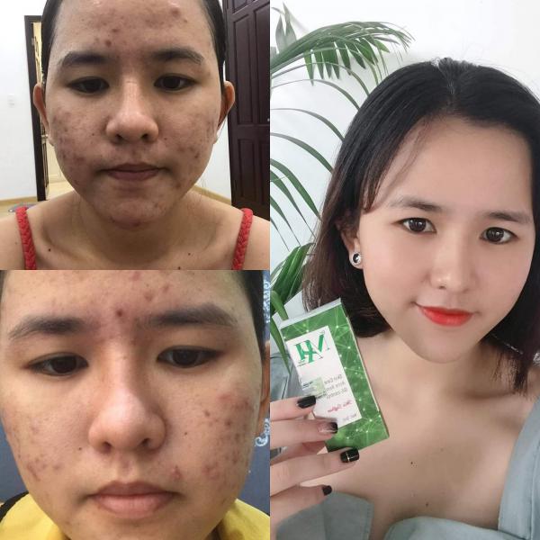 Review trị mụn Dr Mai  